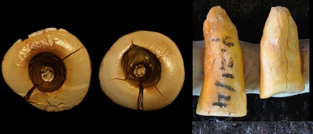 Ancient Dentistry 13,000YearOld Tooth Filling