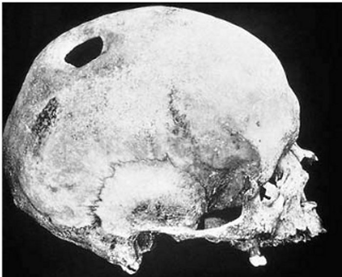 Trephined skull, from an Anglo-Saxon skeleton excavated in East Anglia. Credits: cambridge.org
