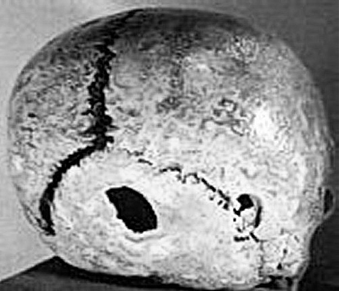 This skull found in Soviet Armenia has more than 4,000 years. However, some surgeons had plugged the hole with a piece of animal bone.