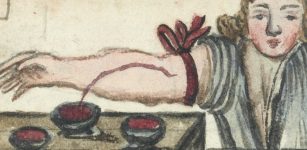 Bloodletting was treatment for infection in the past. Wellcome Library, London, CC BY