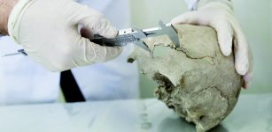 A skull found in one of the graves reveals a successful brain operation from the ancient ages. Photo: AA