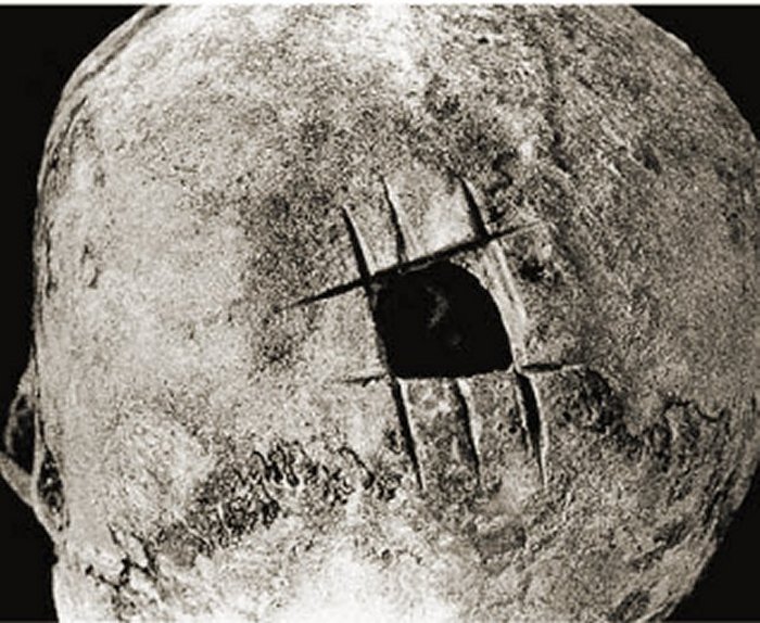 Trepanned skull from ancient Peru. The operation has been performed by means of a series of incisions placed at right angles to each other. Credits: cambridge.org