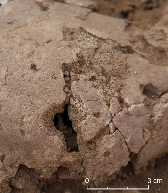 sudan skull trepanation