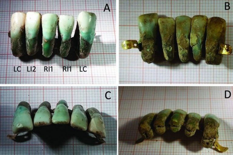 Unique Dental Prosthesis Made Of Human Teeth Found In Medieval Tomb