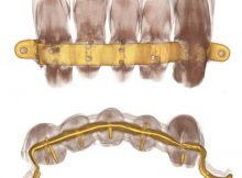 CT images of the prosthesis reveal the small pins placed into the root and blocking the teeth at the internal gold lamina. Credit: Simona Minozzi. Image via Discovery News