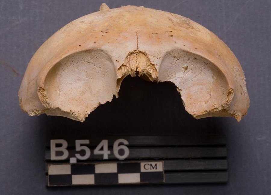 Porosity indicating anemia in the eye sockets of approx. 18 months old child. Photo by Wojciech Wojciechowski/Polish Centre of Mediterranean Archaeology UW