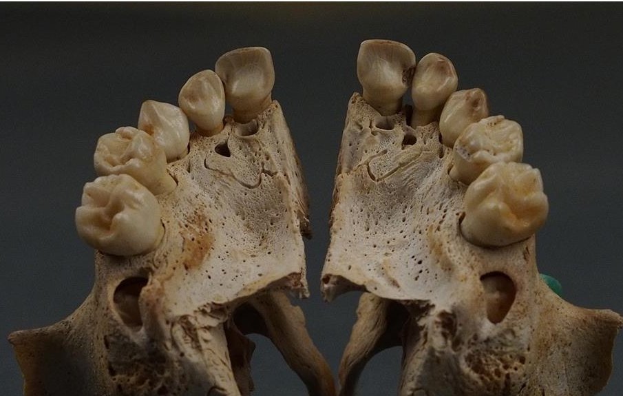 Decay products in the front deciduous teeth of the upper jaw of approx. three years old child. Photo by Jarosław Dąbrowski/Polish Centre of Mediterranean Archaeology UW